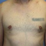 Gynecomastia Before & After Patient #7354