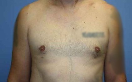 Gynecomastia Before & After Patient #7354