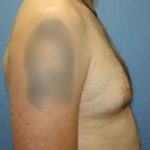 Gynecomastia Before & After Patient #7354