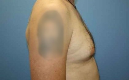 Gynecomastia Before & After Patient #7354