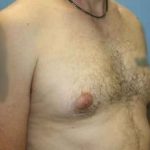 Gynecomastia Before & After Patient #7354