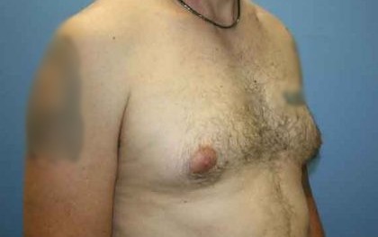 Gynecomastia Before & After Patient #7354