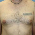 Gynecomastia Before & After Patient #7354