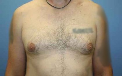 Gynecomastia Before & After Patient #7354