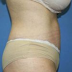 Tummy Tuck Before & After Patient #5584