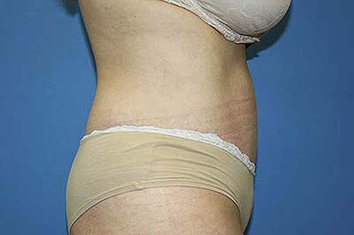 Tummy Tuck Before & After Patient #5584