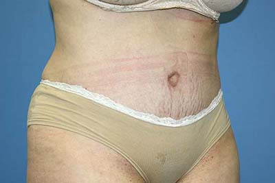 Tummy Tuck Before & After Patient #5584