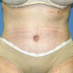 Tummy Tuck Before & After Patient #5584