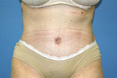 Tummy Tuck Before & After Patient #5584