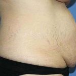 Tummy Tuck Before & After Patient #5584