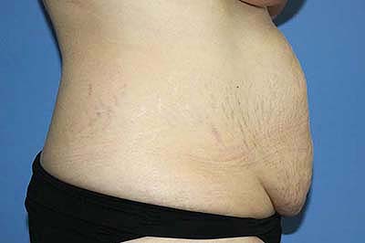 Tummy Tuck Before & After Patient #5584