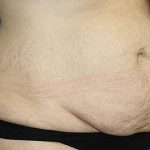 Tummy Tuck Before & After Patient #5584