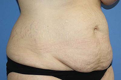 Tummy Tuck Before & After Patient #5584