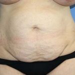 Tummy Tuck Before & After Patient #5584