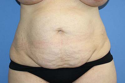 Tummy Tuck Before & After Patient #5584