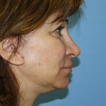 Facelift Before & After Patient #7296