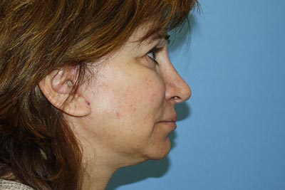 Facelift Before & After Patient #7296