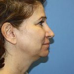 Facelift Before & After Patient #7296