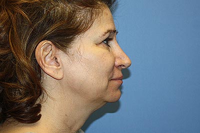 Facelift Before & After Patient #7296