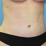 Tummy Tuck Before & After Patient #5616