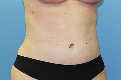 Tummy Tuck Before & After Patient #5616