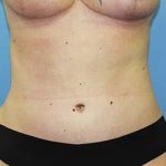 Tummy Tuck Before & After Patient #5616