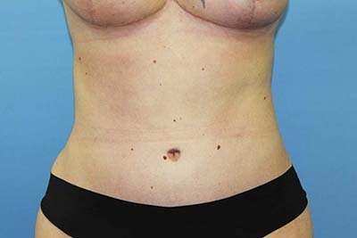 Tummy Tuck Before & After Patient #5616