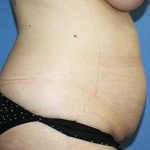 Tummy Tuck Before & After Patient #5616