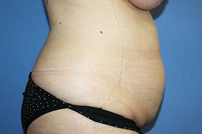 Tummy Tuck Before & After Patient #5616