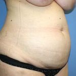 Tummy Tuck Before & After Patient #5616