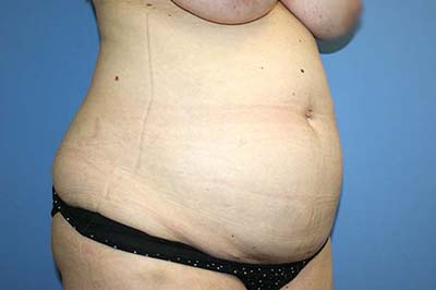 Tummy Tuck Before & After Patient #5616
