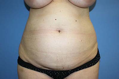 Tummy Tuck Before & After Patient #5616