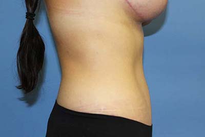 Tummy Tuck Before & After Patient #7241