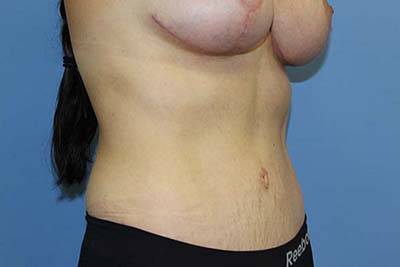 Tummy Tuck Before & After Patient #7241