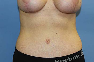Tummy Tuck Before & After Patient #7241
