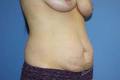 Tummy Tuck Before & After Patient #7241