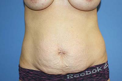 Tummy Tuck Before & After Patient #7241