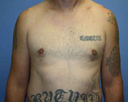 Gynecomastia Before & After Patient #7354
