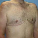 Gynecomastia Before & After Patient #7315