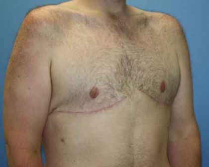 Gynecomastia Before & After Patient #7315