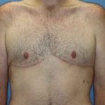 Gynecomastia Before & After Patient #7315