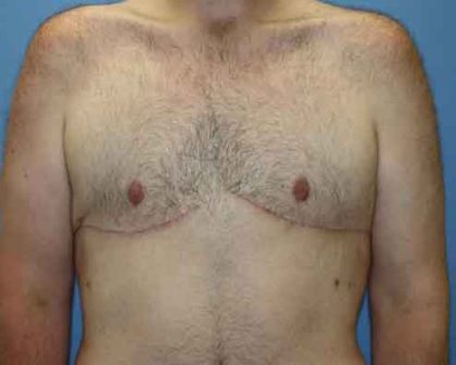 Gynecomastia Before & After Patient #7315