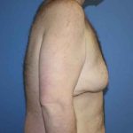 Gynecomastia Before & After Patient #7315