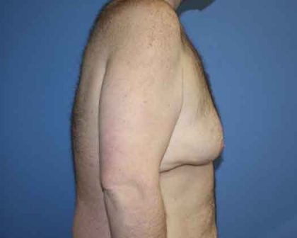 Gynecomastia Before & After Patient #7315