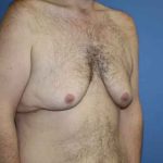 Gynecomastia Before & After Patient #7315