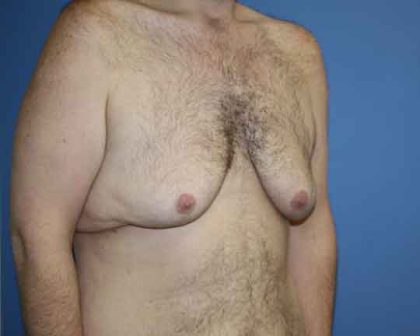 Gynecomastia Before & After Patient #7315