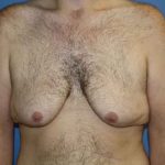 Gynecomastia Before & After Patient #7315