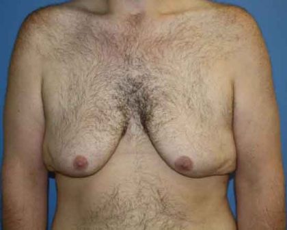 Gynecomastia Before & After Patient #7315