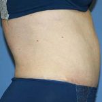 Tummy Tuck Before & After Patient #5621