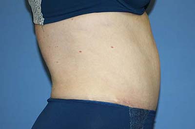 Tummy Tuck Before & After Patient #5621